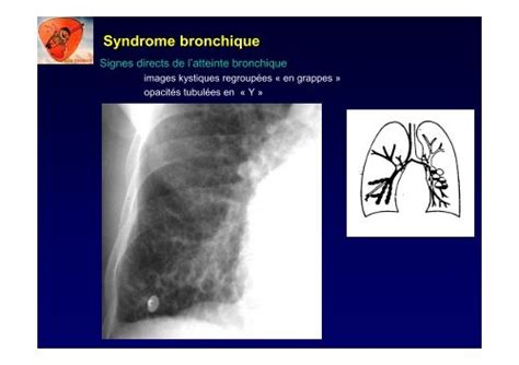 Syndrome Bronchique Signe