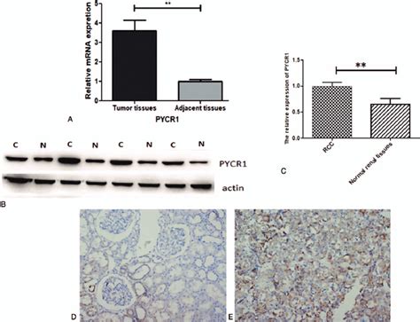 Expression Of Pycr1 Mrna And Protein In Rcc And Paired Adjacent Normal