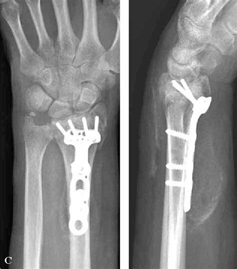 Distal Radius Fracture Volar Plate