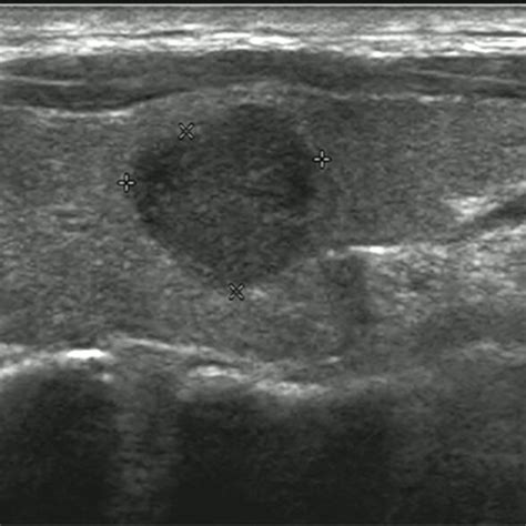 Computed Tomography Ct Images Of Medullary Thyroid Cancer Mtc In