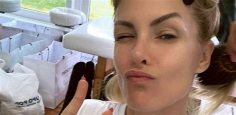 Ana Hickmann faz novo post após aparecer na TV hematoma Força