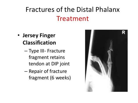 Distal phalanx fracture