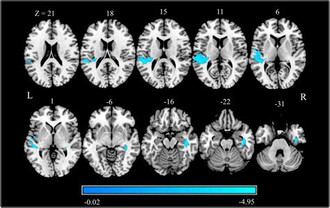 Frontiers Structural And Functional Brain Changes In Patients With