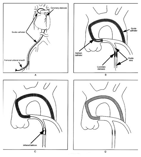 Percutaneous Transluminal Coronary Angioplasty NEJM