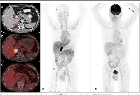 Figure 2 From University Of Groningen Lesion Detection By Zr 89 Zr DFO