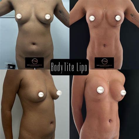 Antes Y Despu S Lipoescultura Mamoplastia De Aumento De Eliana Garc S