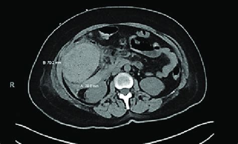 Ct Showing Retroperitoneal Hematoma Centered About The Right Anterior Download Scientific