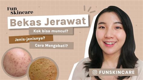 Skincare Untuk Bekas Jerawat Pih Pie Bopeng Skintalk Youtube