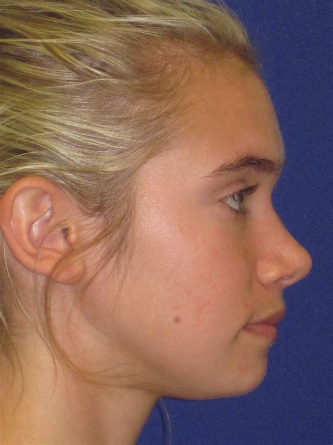 Saddle Nose Rhinoplasty Philadelphia Pa Nose Surgery By Dr Anthony Corrado