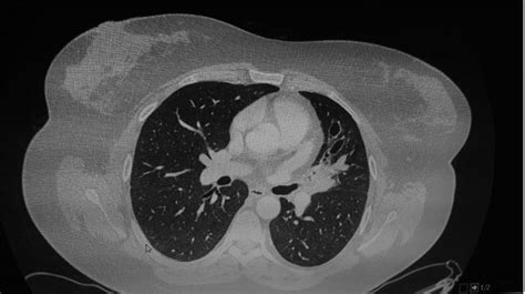 PACIENTE CON SÍNDROME HIPER IGE CON ASPERGILOSIS BRONCOPULMONAR