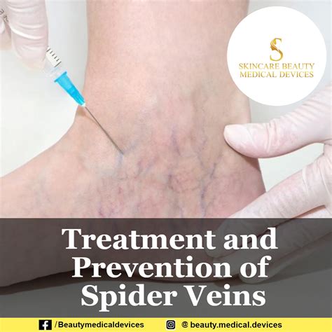 Treatment And Prevention Of Spider Veins