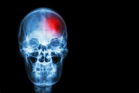 How To Recognise A Stroke And What You Should Know About Their Treatment