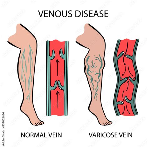 venous disease varicose veins  human legs twisting  dilation