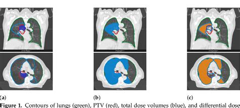 Figure From Carbon Monoxide Diffusing Capacity Dlco Correlates With