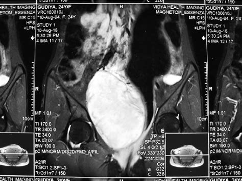 Coronal Section Of T2 Weighted Mri Pelvis Showing The Pelvic Mass