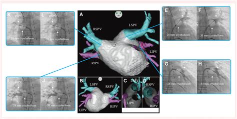 Figure 3 From Occlusion And Catheter Ablation Using A Large Size Cryoballoon For Various