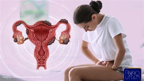 Unam On Twitter La Endometriosis Aumenta El Riesgo De Desarrollar