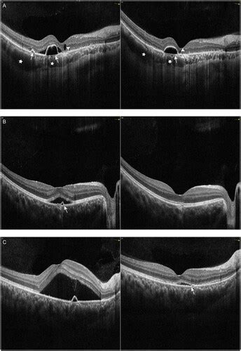 Full Article Intravitreal Injections With Anti VEGF Agent Aflibercept