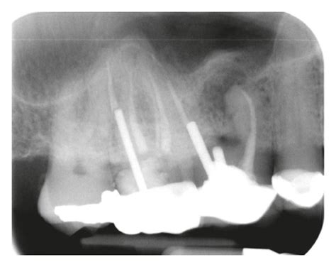 Radiograph Of Tooth Showed Periapical Radiolucency On The Mesial