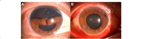 Preoperative And Postoperative Slit Lamp Photographs Of Iridodialysis