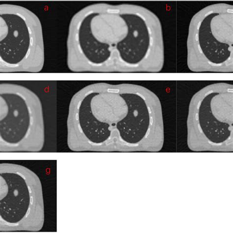 Hrct Image And Srct Images Of Xcat Phantom From Different Methods A