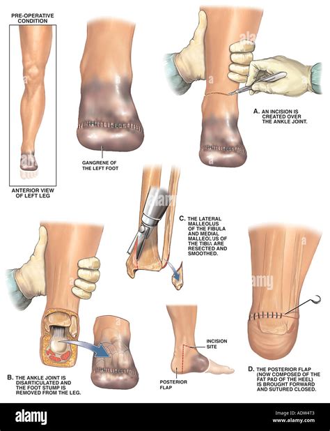 amputate amputation amputated  res stock photography  images alamy