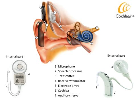 Cochlear Implant | Electronic Device Provides Sound For Deaf