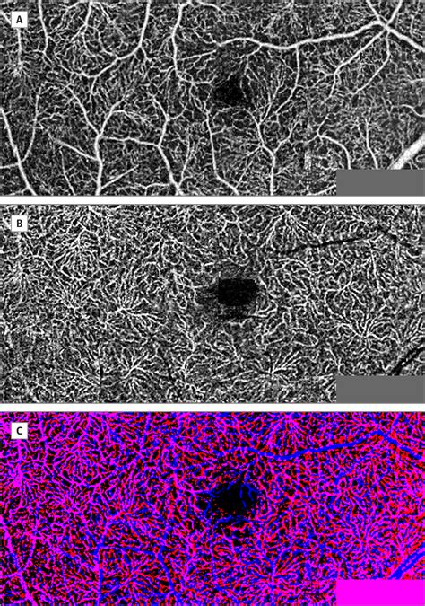 Retinal Vascular Layers In Macular Telangiectasia Type Ophthalmic