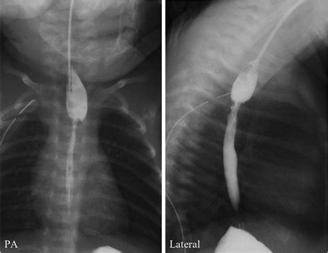 Esophageal Atresia X Ray