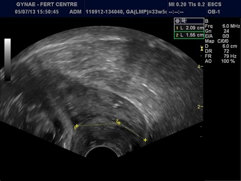 Suggested Method For The Management Of Heterotopic Cervical Pregnancy