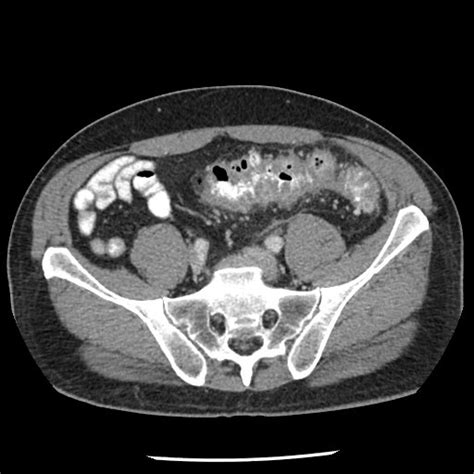 Diverticulitis On Ct Scan