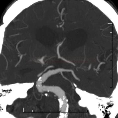 Dolichoectasia Stroke Manual