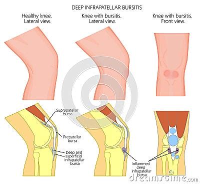 Knee Bursitis Deep Infrapatellar Bursitis Cartoon Vector