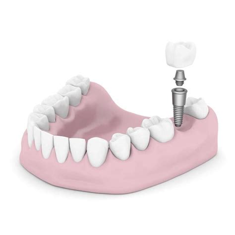 Dentist Implants Woodland Hills CA Benefits Of Dental Implants