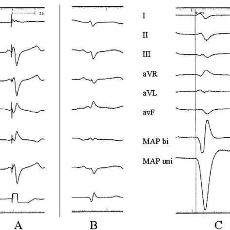 Mapping Of The Site Of Earliest Activation Of Escape Rhythm A Pace