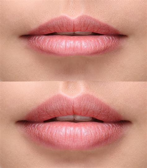 lip before and after Dreamstime