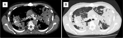 Eggshell Calcification