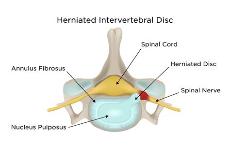 Lumbosacral Radiculopathy (Sciatica) | My Doctor Online