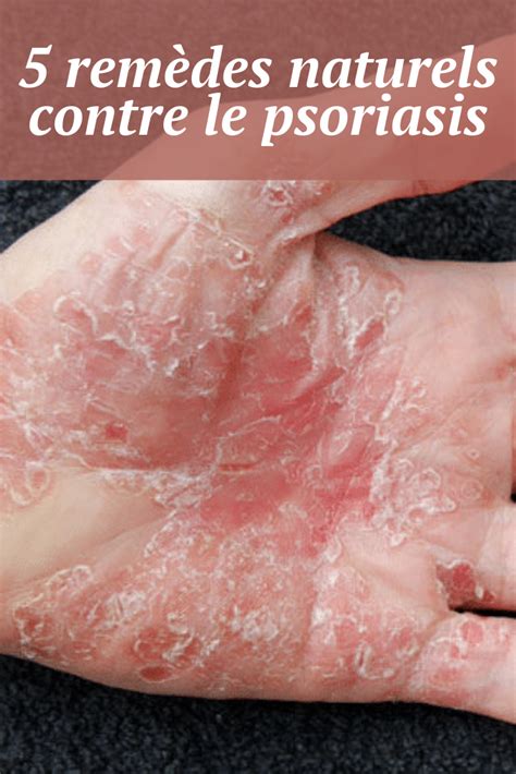 Rem Des Naturels Contre Le Psoriasis Astucieusement