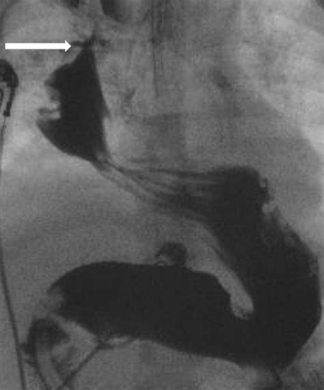 The Use Of A BioPlug For Closure Of A Neo Esophagocutaneous Fistula