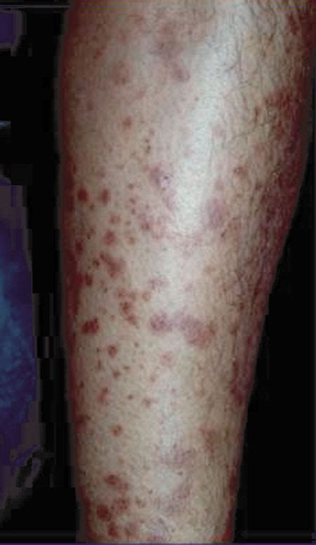 Aids Lesions On Legs