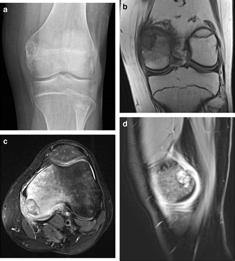 Chondroblastoma In A 16 Year Old Boy With Knee Pain Who Was Found To