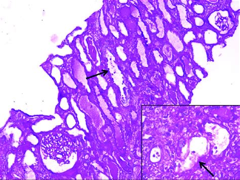 Section From Renal Biopsy Shows Unremarkable Glomeruli And Dilated