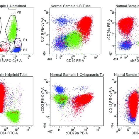 Acute Myeloid Leukemia With Aberrant Expression Of CD7 Blasts Are