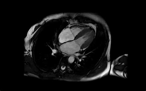 Resonancia cardíaca qué es Origen Diagnóstico y traumatología