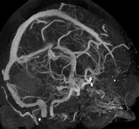 New Techniques In Ct Angiography Radiographics