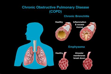 Copd Classification Mara Stacey