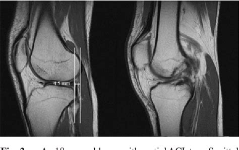 PDF Anterior Tibial Translation Sign Factors Affecting