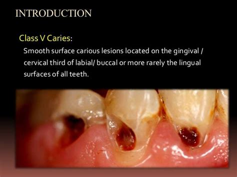 Management Of Class V Caries