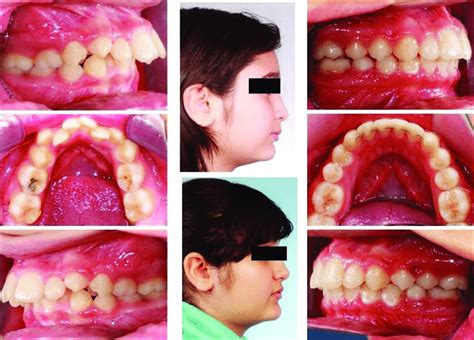 An Example Of Class Ii Division 1 Treatment Intraoral Photographs On Download Scientific